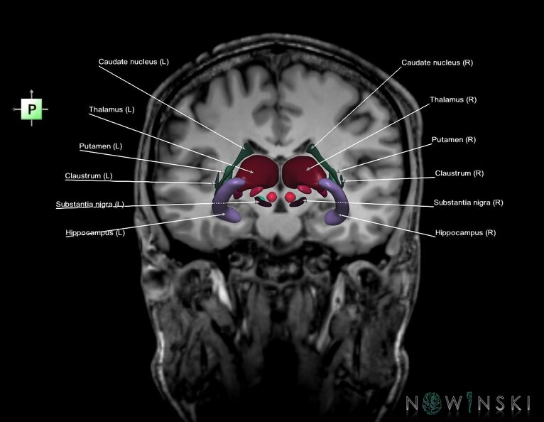 G6.T11.1.V3.P-17S.Deep_nuclei_all–Triplanar.tiff