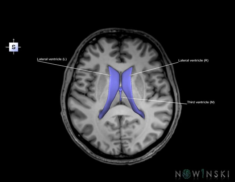 G6.T12.V5.P09S.Cerebral_ventricles–Triplanar.tiff