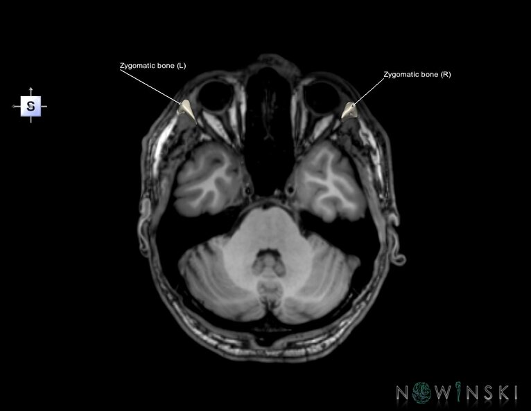 G6.T22.5.10.V5.P-30S.Zygomatic_bone–Triplanar.tiff