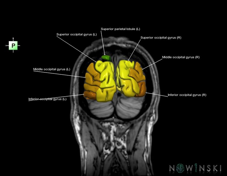 G6.T3.1.V3.P-80S.Cerebrum–Triplanar.tiff